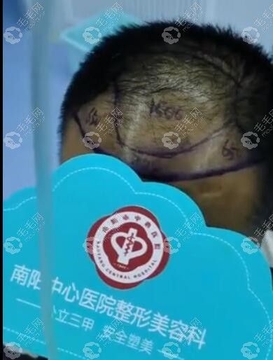我在南阳市中心医院植发的过程