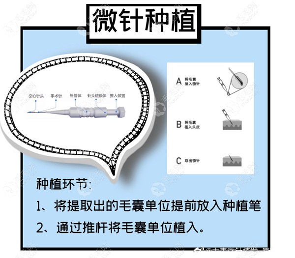 大麦微针植发技术原理与使用器械