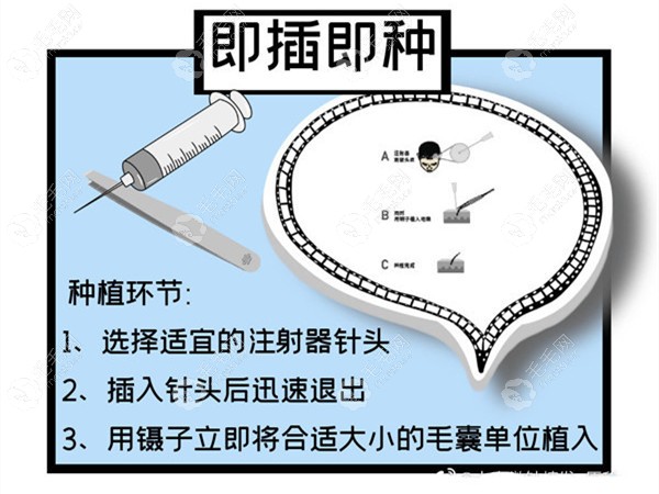 “假的”微针植发技术器械