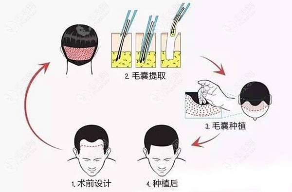 自体毛囊移植普通植发