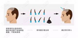 致发友:意大利蛋白纤维植发和普通植发的区别在哪儿?