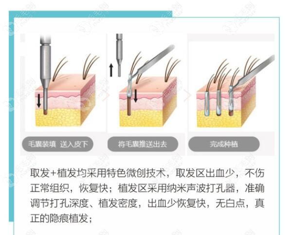 柔性针法、营养液培育毛囊