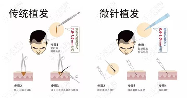 植发技术越发成熟