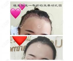 发际线下调2厘米花了3万多,植发2350单位毛囊后大脑门不见了