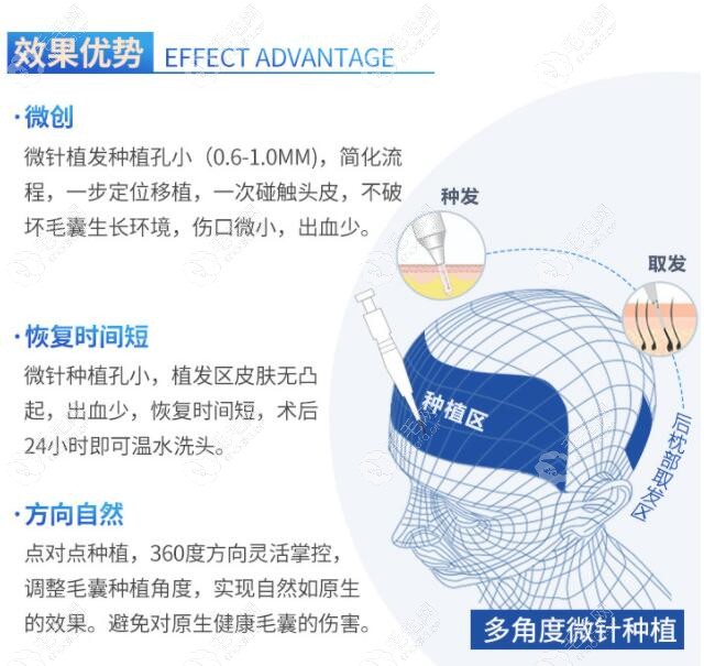 沈阳大麦微针植发3000毛囊是多少钱