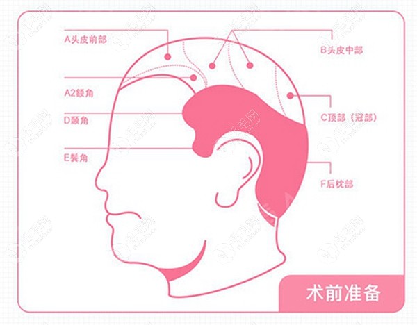 秦皇岛巧致擅长FUE植发