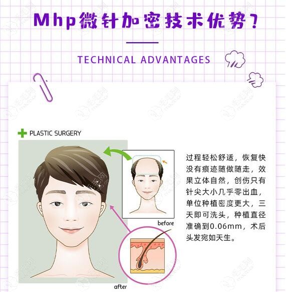 衡阳美莱MHP微针加密技术的优势