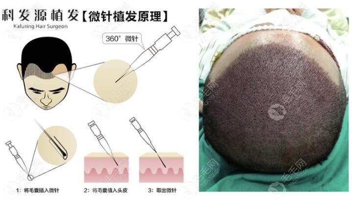 微针植发的效果图