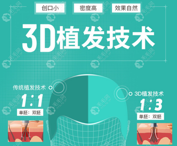 新生3D毛发移植技术
