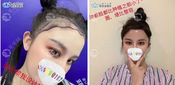 成都碧莲盛女士不剃发发际线种植即刻效果