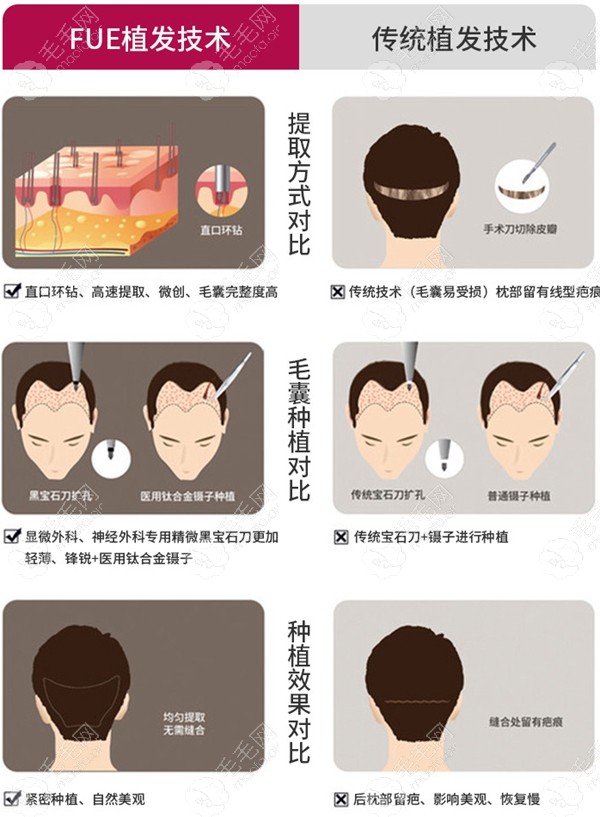 保定华美FUE植发技术优势