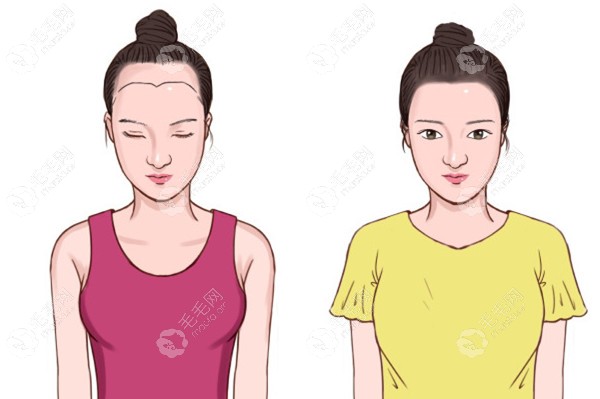 植发手术前后效果对比示意图