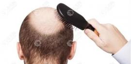 做意大利生物蛋白纤维植发前了解它的危害和副作用很重要