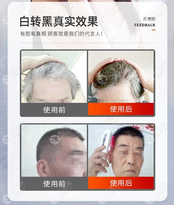 用激光生发梳治疗白转黑的用户