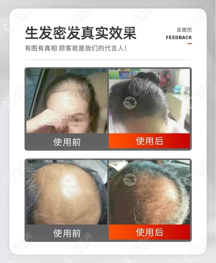 用马宁激光生发梳来密发的顾客