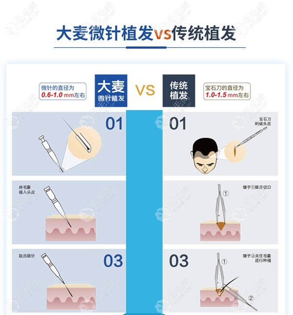 大麦微针植发技术与传统植发对比