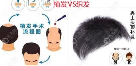 織發(fā)補(bǔ)發(fā)和植發(fā)哪個(gè)好?搞懂它們的區(qū)別后才能知道選誰好些