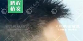 深圳鹏程医院植发评价:找谢斌做完鬓角种植我这么看他