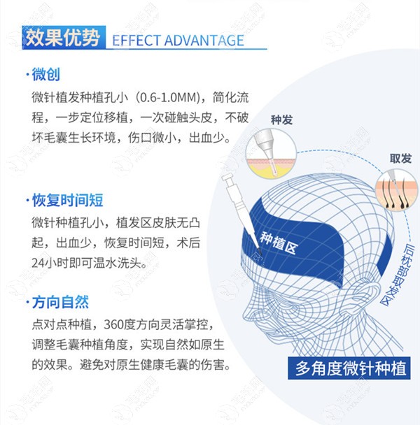 合肥大麦微针植发技术优势