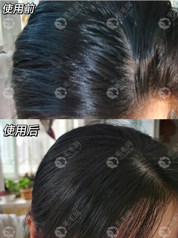 kimtrue且初头皮净透凝露官方使用对比图
