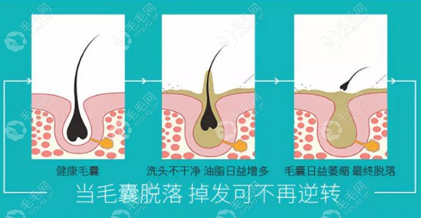 脱发初期，通过药物和养护方式激活毛囊