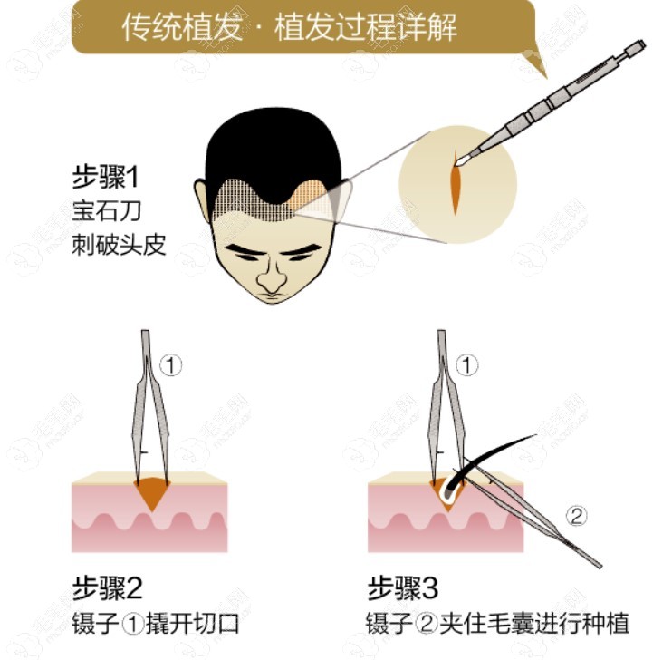 传统植发过程