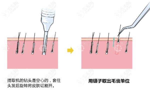 胡须毛囊能种植头发