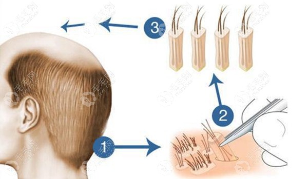 FUE无痕植发技术