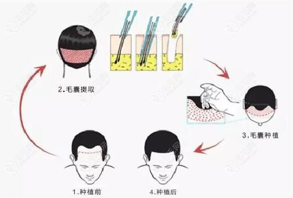 植发7-9个月了还是很稀疏,想知道植发密度不够二次怎么修补