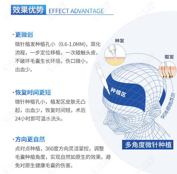 成都大麦植发医生蒋任才擅长微针植发