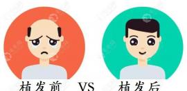 自贡植发医院哪家看脱发好的答案公布,还有植发费用供参考