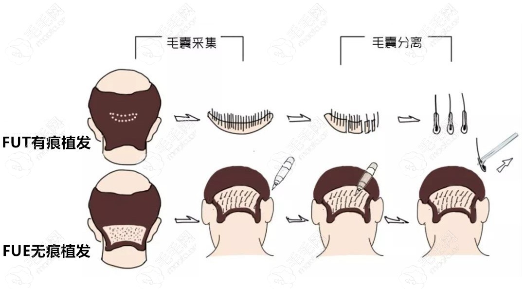 fue和fut植发过程演示