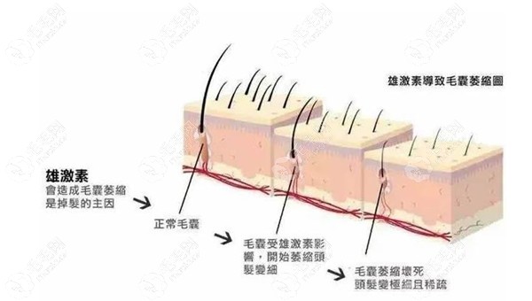 引起雄脱（遗传脱发）的原因