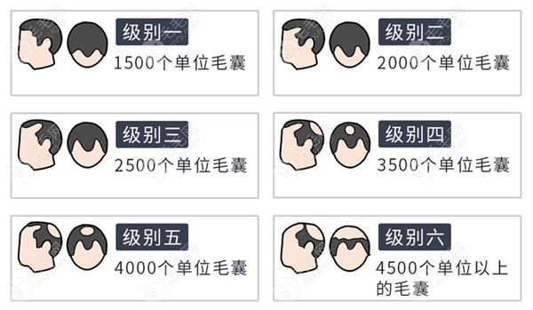 5级脱发4000单位够么