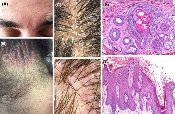 脂溢性皮炎导致的脱发