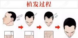 晉城植發(fā)價(jià)格一般是多少?種發(fā)一千單位的費(fèi)用大概需要多錢(qián)