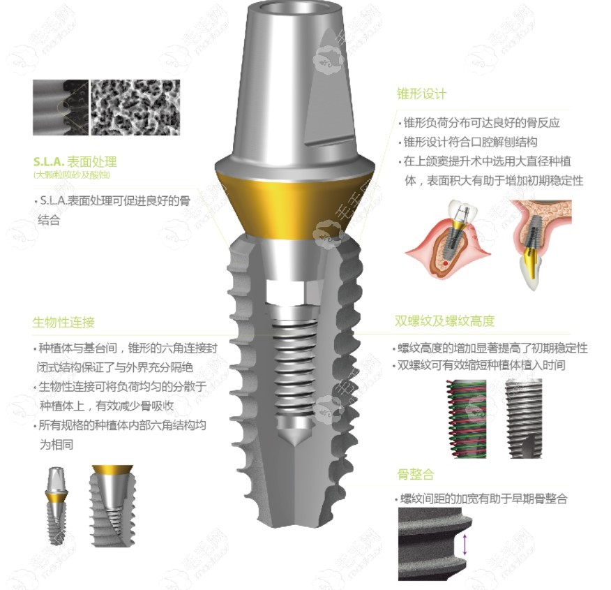 登腾种植体一代设计特点及优势体现