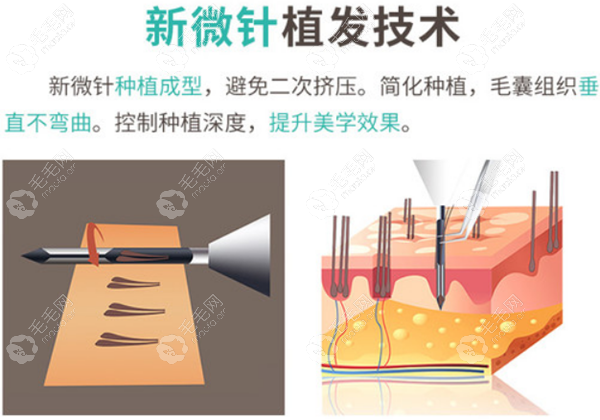 贵阳植发际线哪家医院比较好?发际线后移/脱发来这里就对了