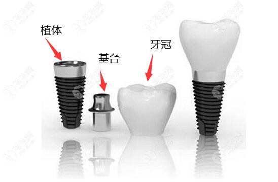 十大世界种植体品牌排行榜名称及价格,种牙如何选有答案了