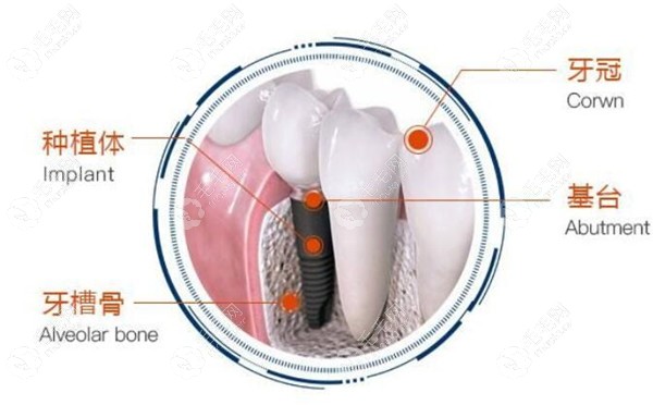 种植牙材料韩国和瑞士哪个更好?都是纯钛价格差别却那么大