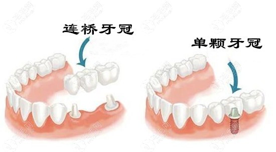 种植牙做连冠好还是单冠好