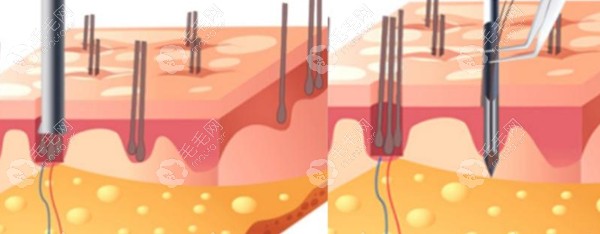 植发技术的取毛囊过程