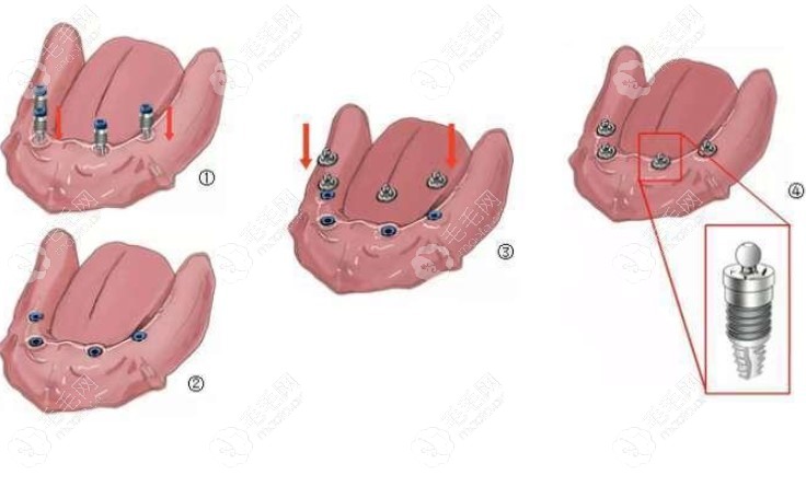 半口四颗半固定种植牙示意图