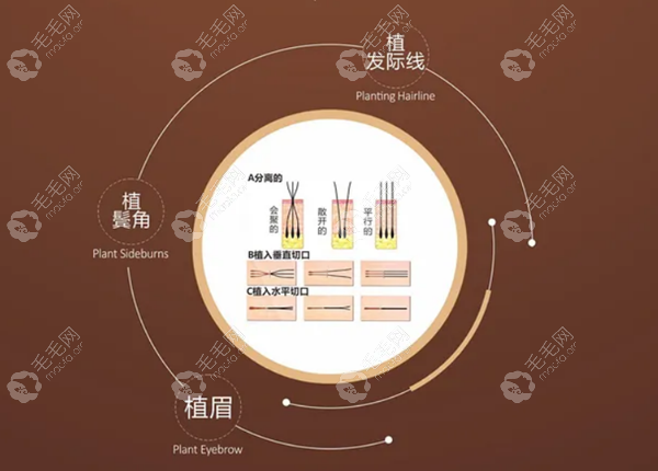 山东临沂华美FUE技术