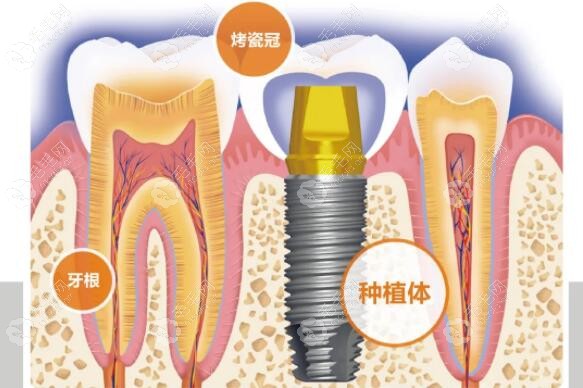 种植牙和真牙的区别