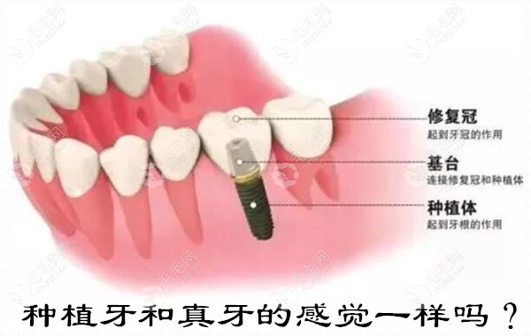 种植牙和真牙的感觉一样吗