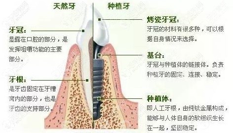 穿颧和穿翼板种植牙价格区别