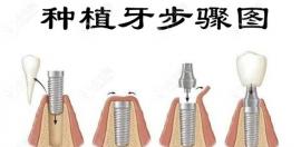 即刻种植牙好还是普通延期3月后种植好?区别不仅是时间哦