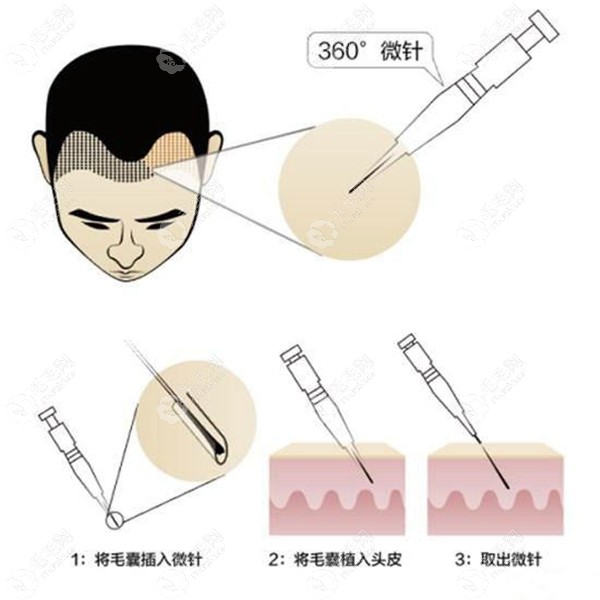 微针植发过程