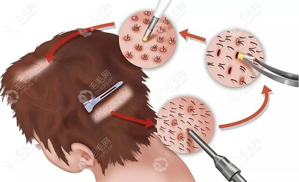 植发就是把后枕区的头发移植到脱发区域